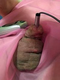 Electrostim urethral sound 1