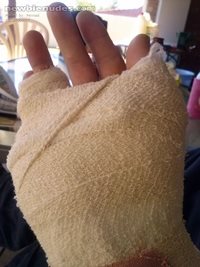 Broken hand, anyone want to give me a hand job